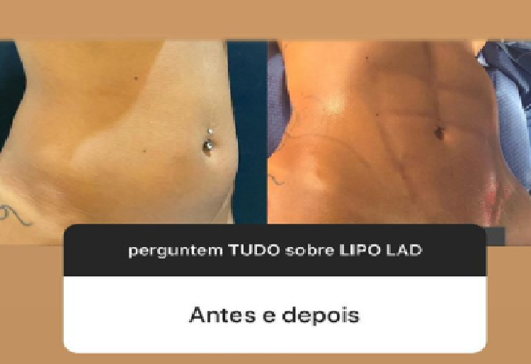 Antes e depois da Lipo LAD - Reprodução do Instagram da Brunna Gonçalves