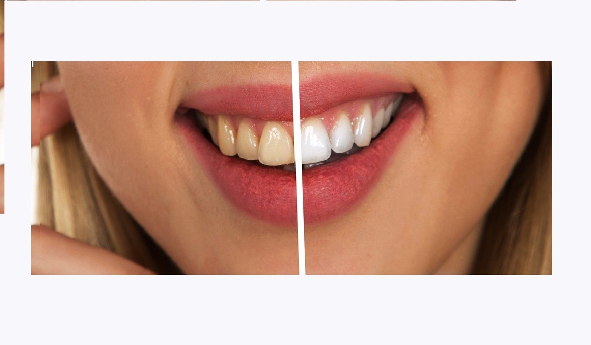 Clareamento dental: descubra como deixar seus dentes brancos em casa - Pixabay