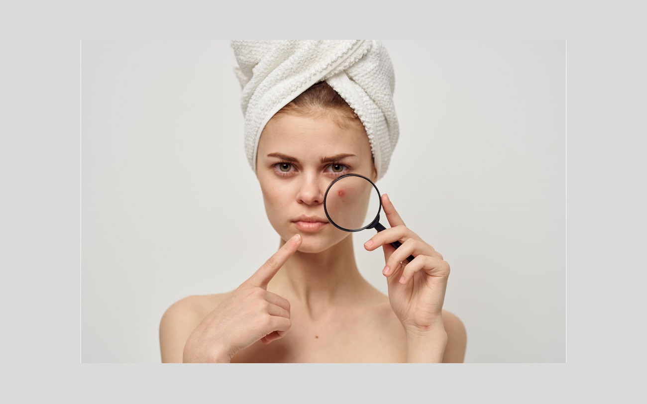 Cuidados com a pele descubra como clarear manchas de acne com apenas 1 ingrediente - canva