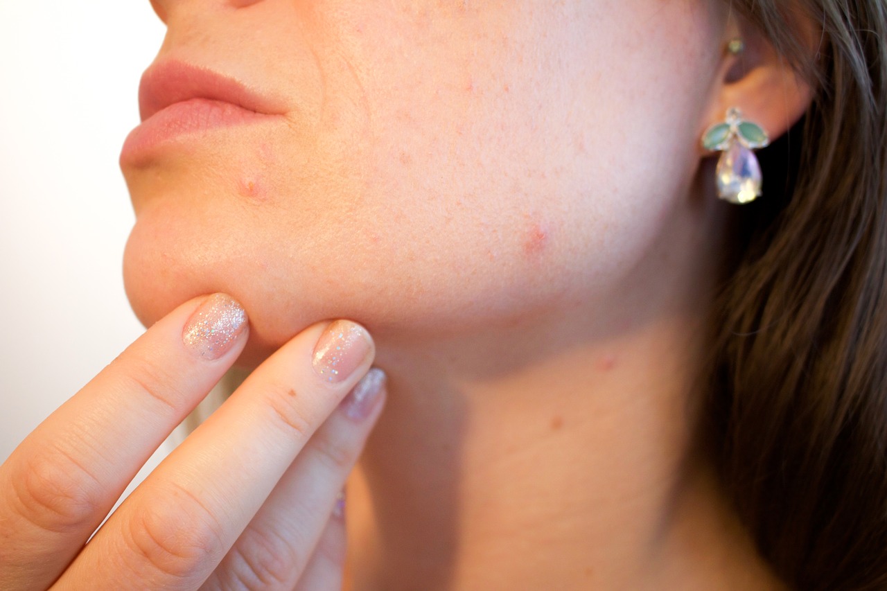 Cravos e espinhas: veja como prevenir e acabar com a acne adulta - Reprodução Pixabay