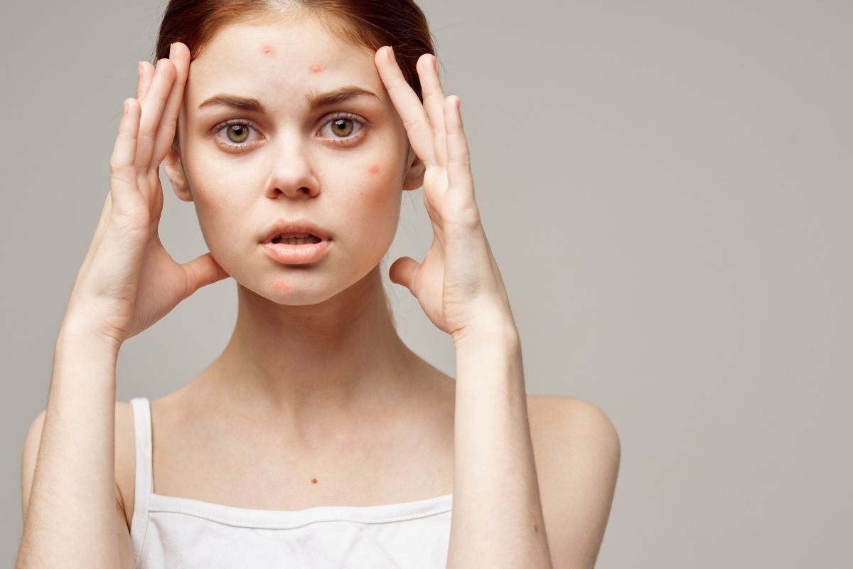 máscara potente para acabar com as acnes - reprodução do canva